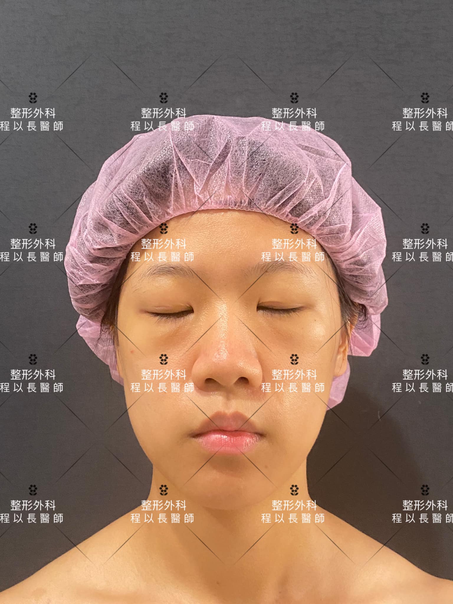 客製化雙眼皮手術大小眼 眼袋脂肪凸出改善眼神無神