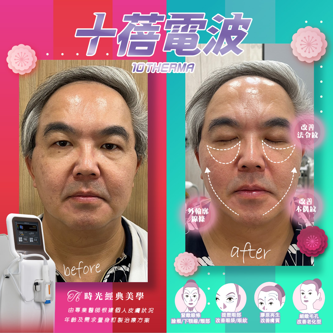 新一代電波拉皮 十蓓電波